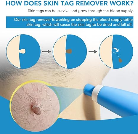 Acrochordon Skin Remover Kit My Store