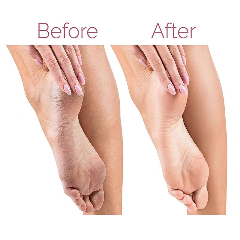 Rechargeable Electric Foot Callus Remover Souq Rukna Al Khaleej